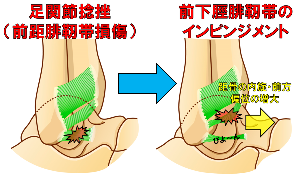 前 脛 腓 靭帯